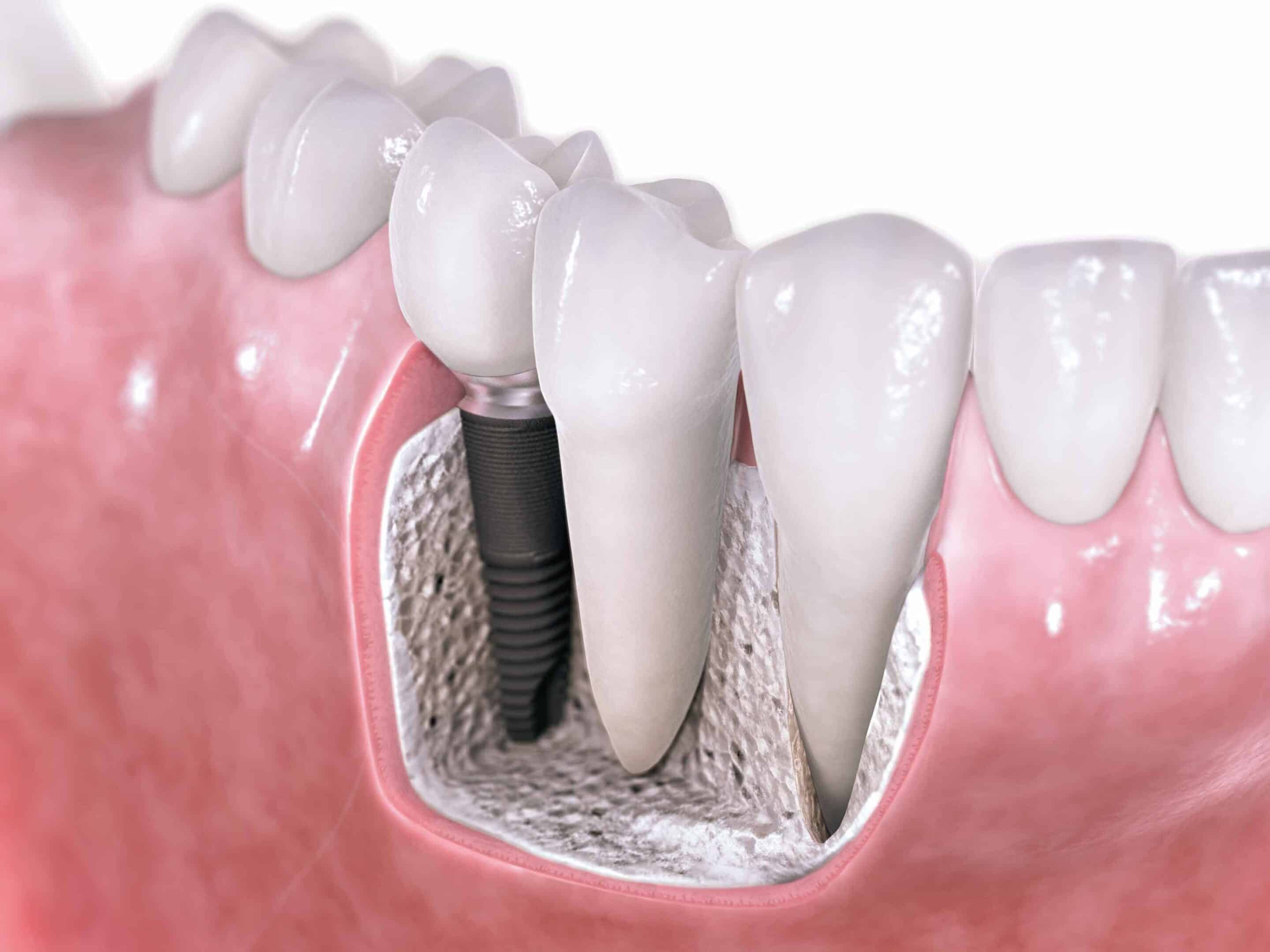 Implante com dente solto – é grave? Veja aqui como resolver