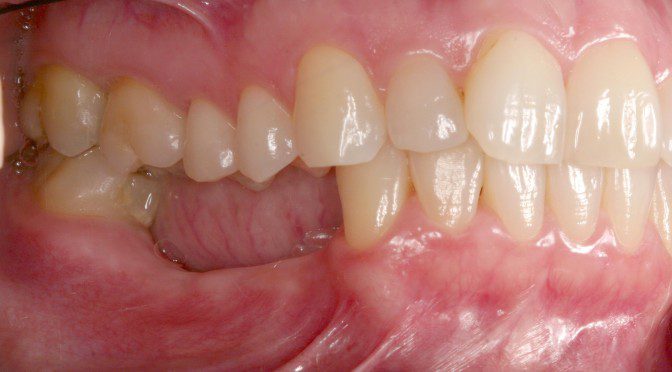 Consequências da perda de um dente