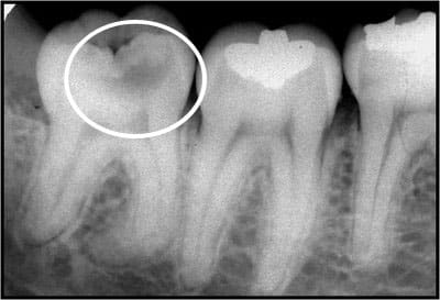 Cárie Dentária – o que é e como se desenvolve?
