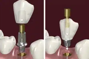diferenças entre coroa cimentada e coroa aparafusada de um implante